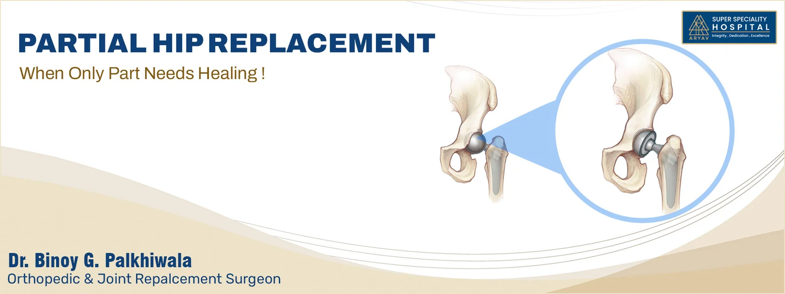 Partial Hip Replacement