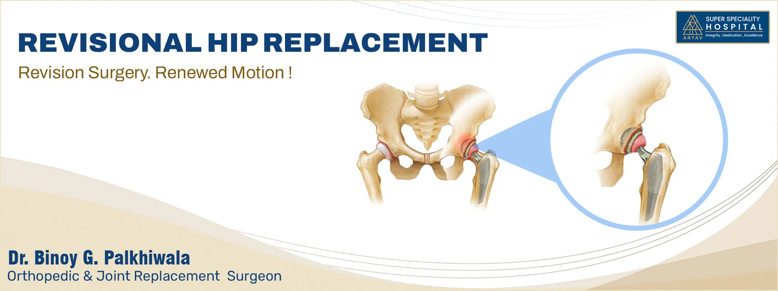 Revision Hip Replacement